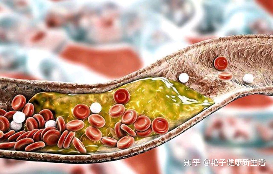 胆固醇高的饮食一览表